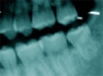 X-rays of the teeth lead to disability